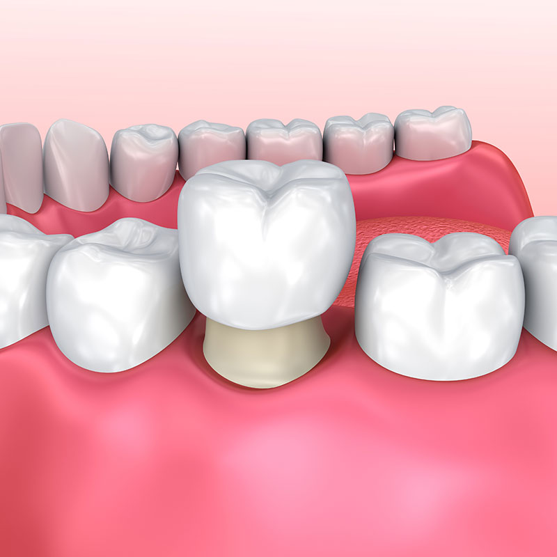 Dental Crowns | Ambleside | Zebra Dental