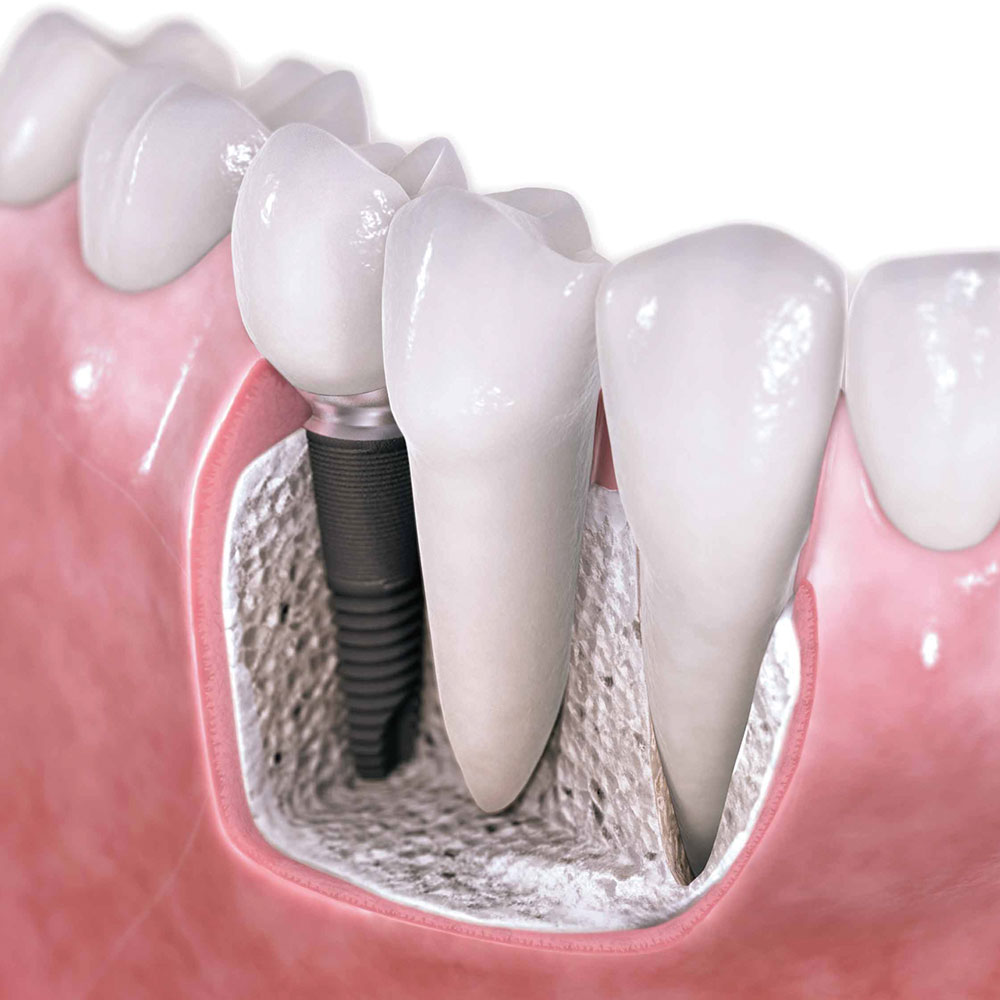 Replace missing teeth with Dental Implants | Zebra Dental Windermere