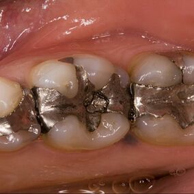 Silver Fillings | Zebra Dental Windermere