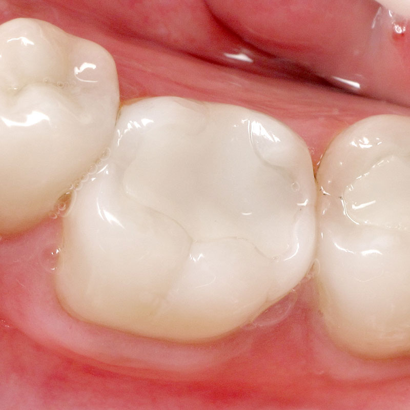White Fillings | Zebra Dental WindermerePicture